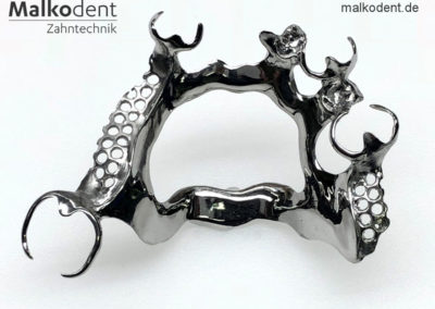 Cast partial denture with metal clip